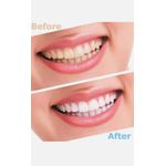 Private: Oral Hygiene Teeth Whitener led light wireless Kits teeth whitenin kit 3